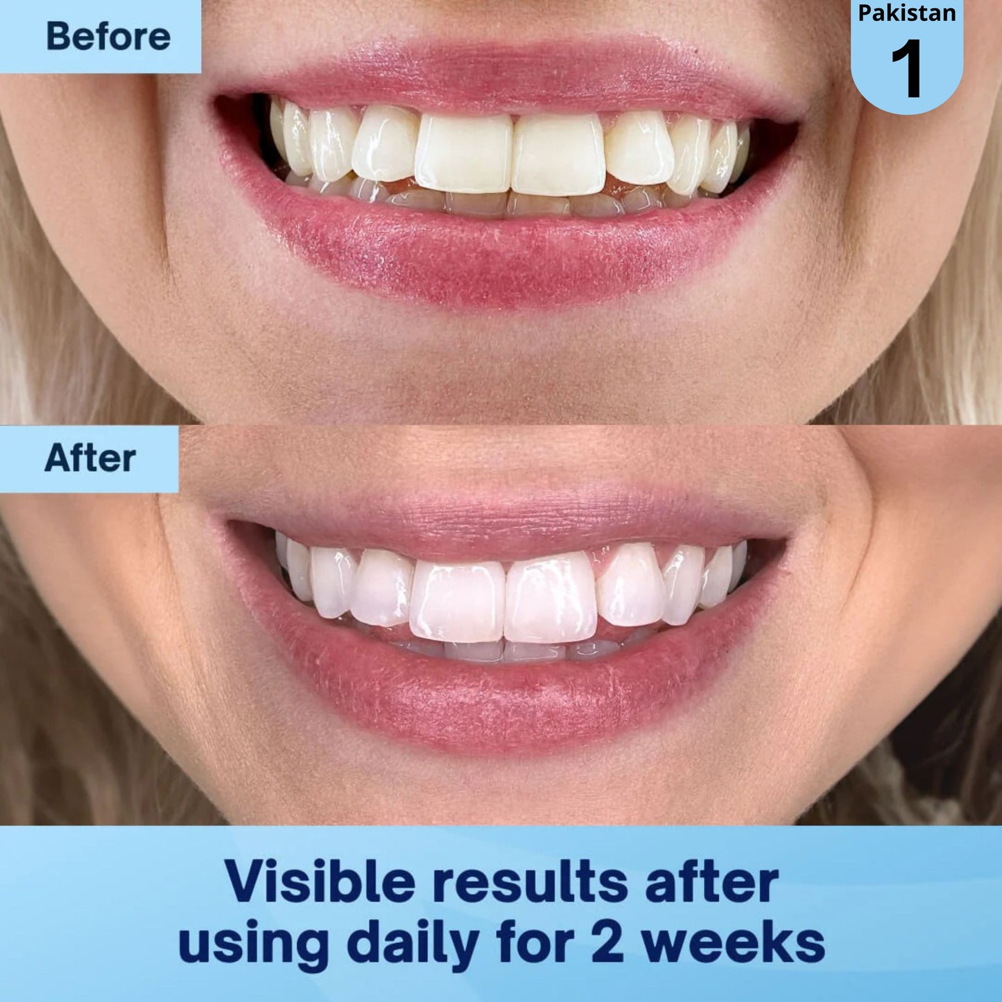 Dentist Approved Teeth Whitening Powder